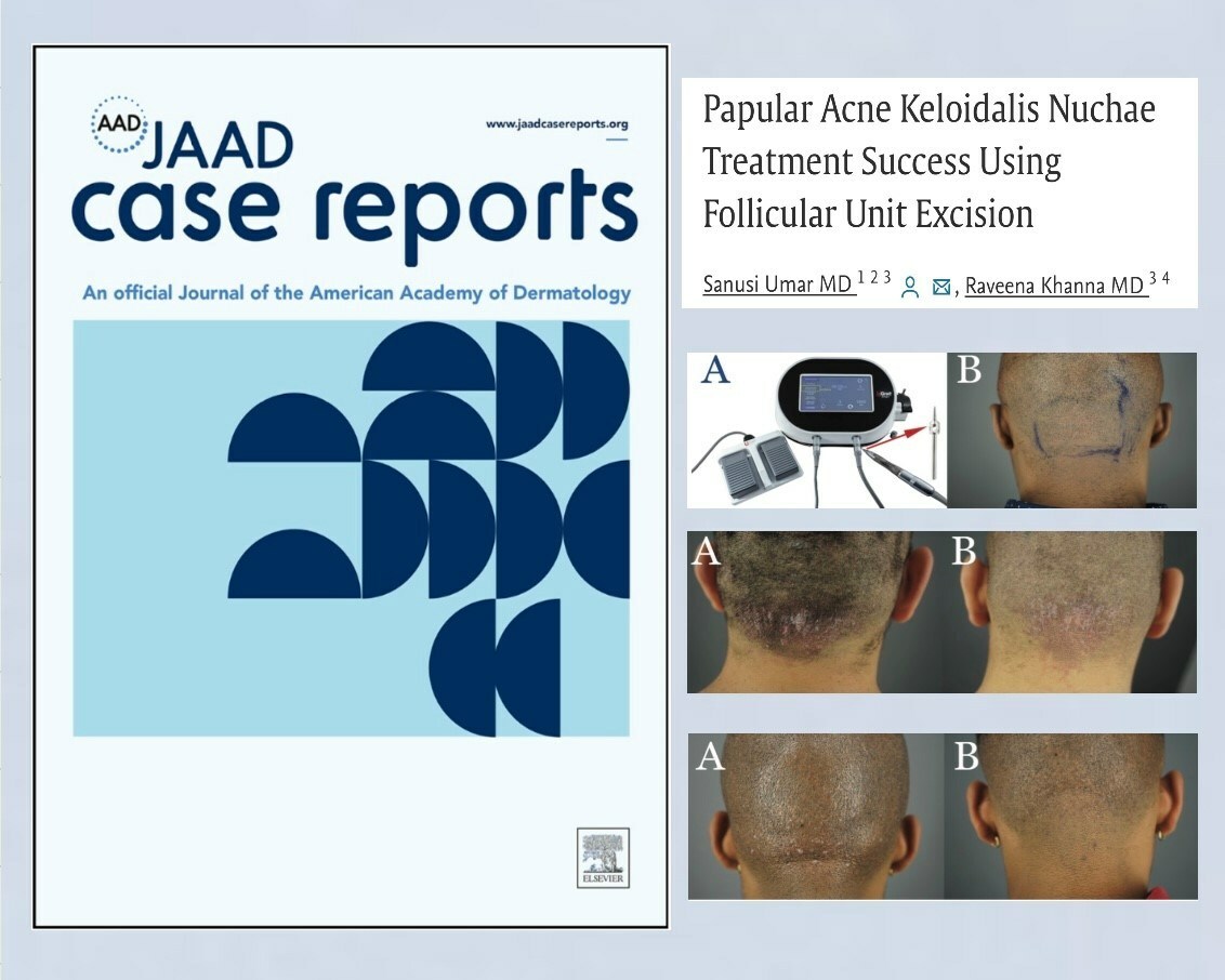 Recent Research Reveals New Hope for Treating Acne Keloid (AKN)